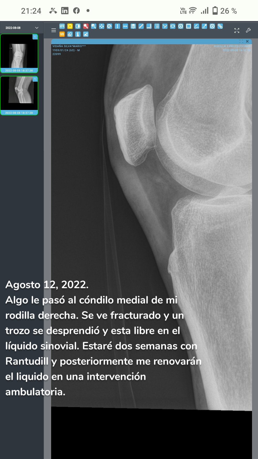 Agosto 12, 2022.
Algo le pasó al cóndilo medial de mi rodilla derecha. Se ve fracturado y un trozo se desprendió y esta libre en el líquido sinovial. Estaré dos semanas con Rantudill y posteriormente me renovarán el liquido en una intervención ambulatoria.